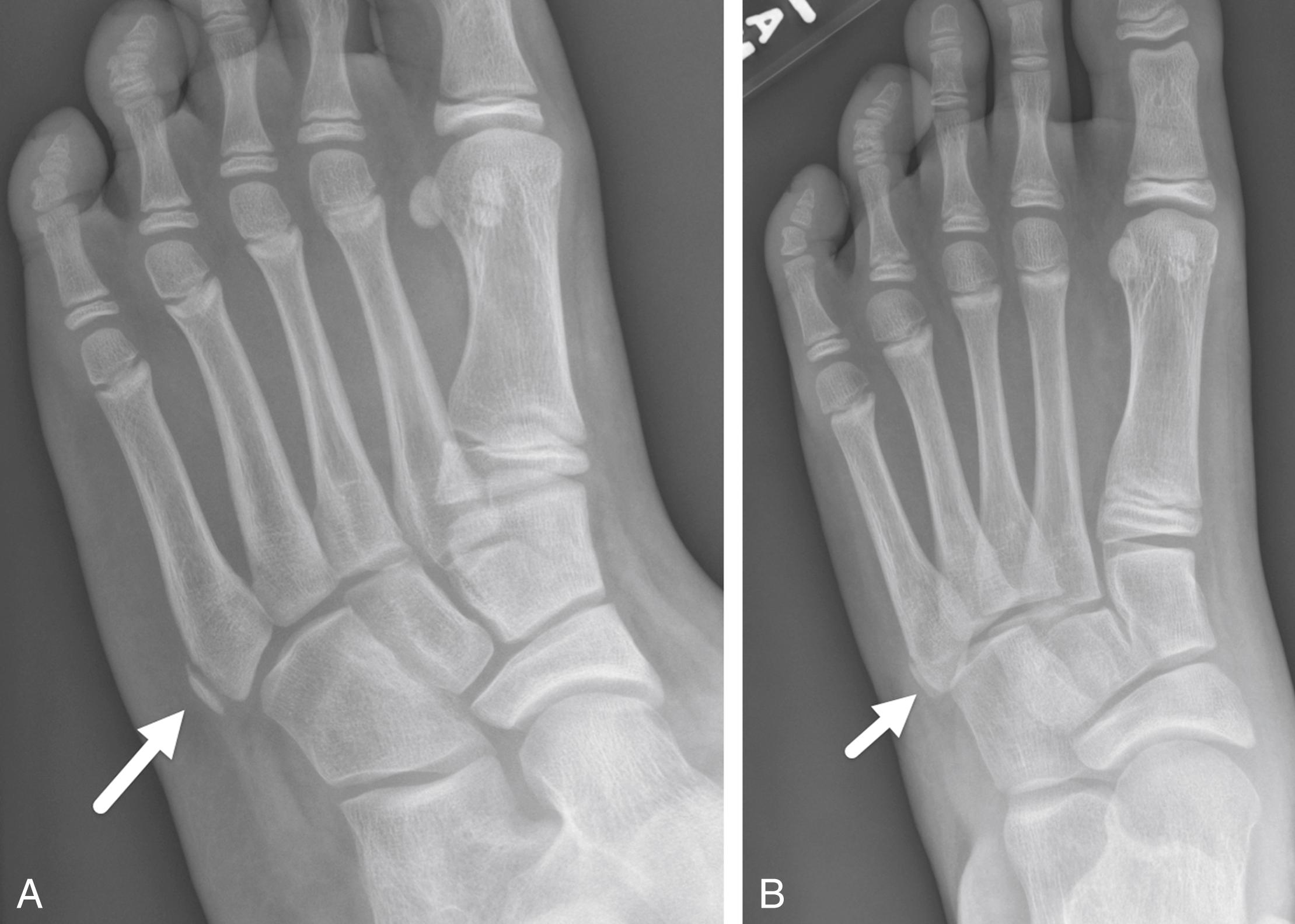 FIGURE 7-46, Normal apophysis of the fifth metatarsal.