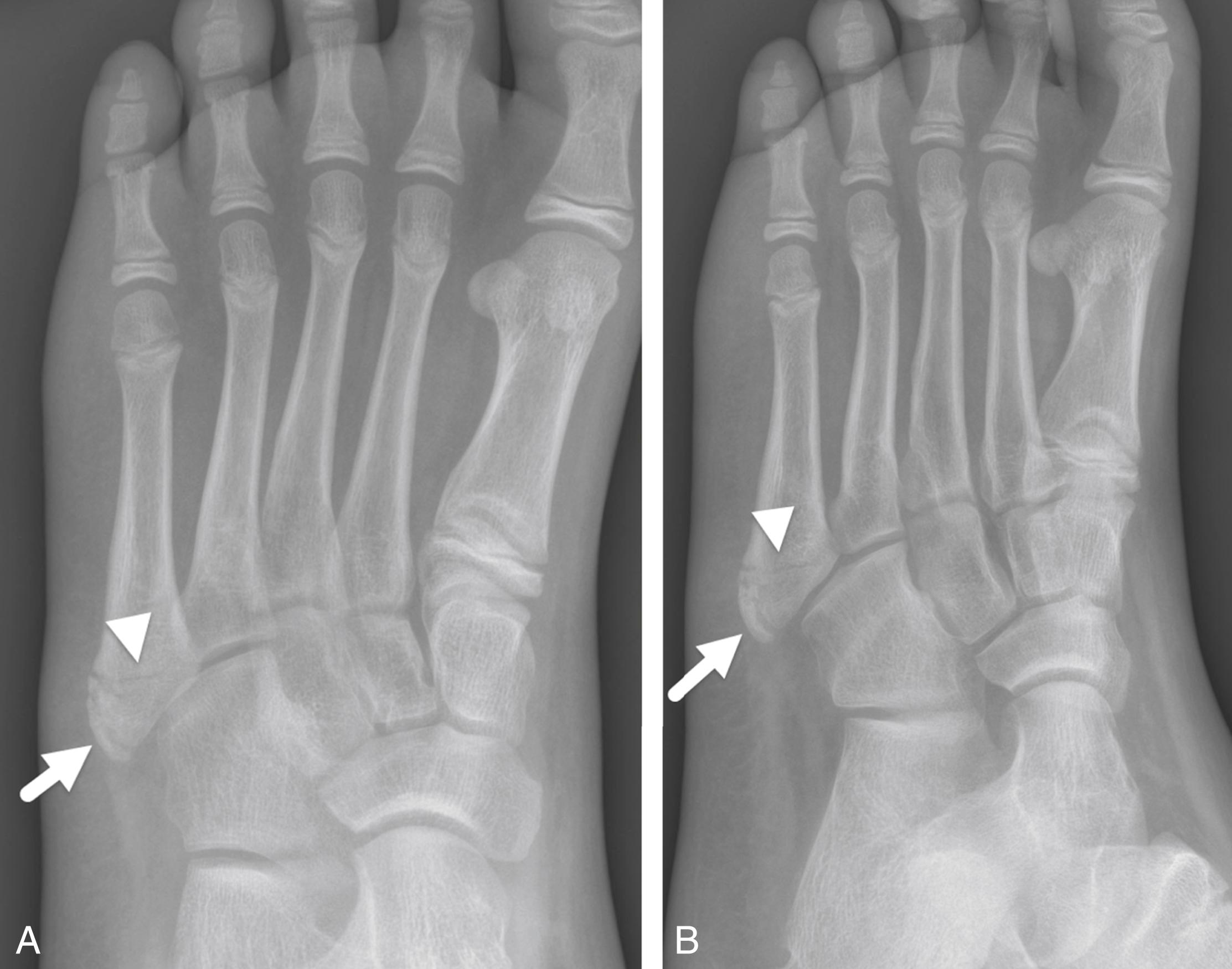 FIGURE 7-47, Difference between a normal apophysis and fracture of the fifth metatarsal.