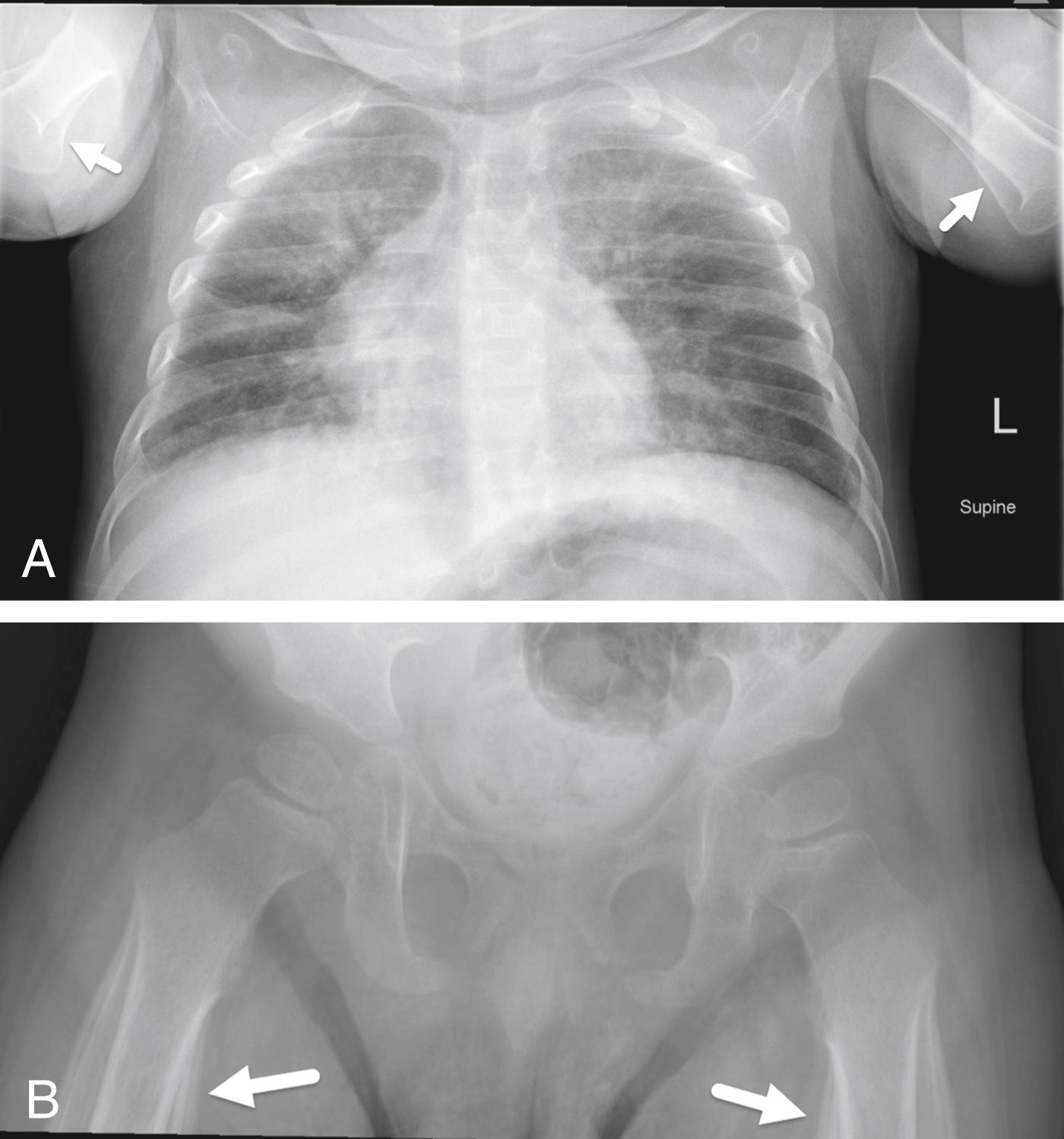 FIGURE 7-50, Diffuse periosteal new bone formation.