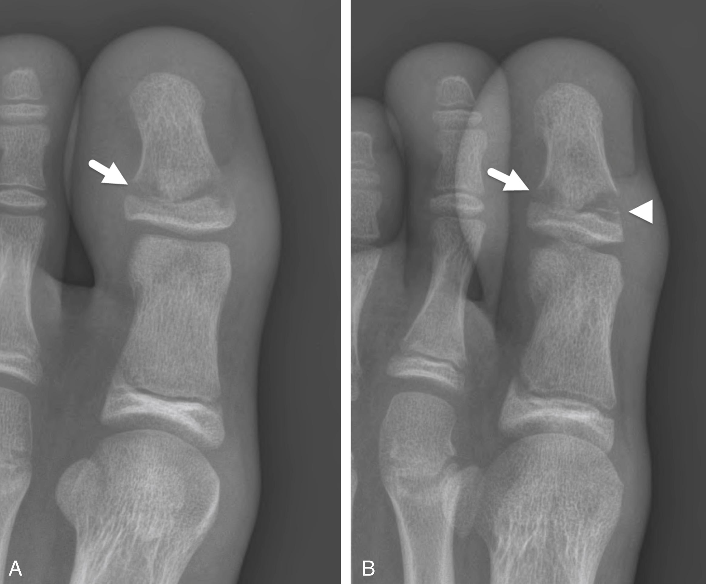 FIGURE 7-51, Osteomyelitis of the great toe.