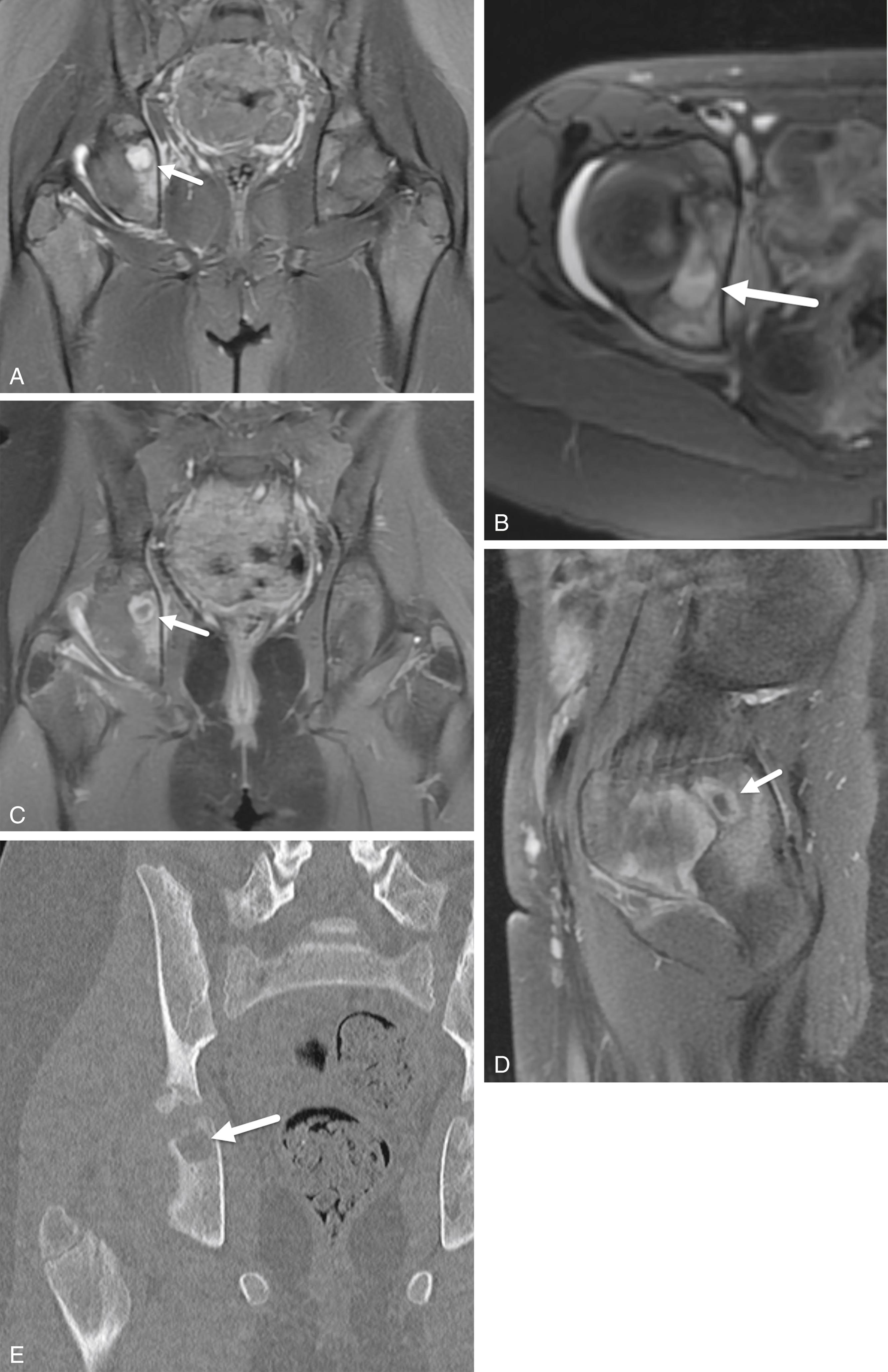 FIGURE 7-52, Brodie abscess of the ischium.