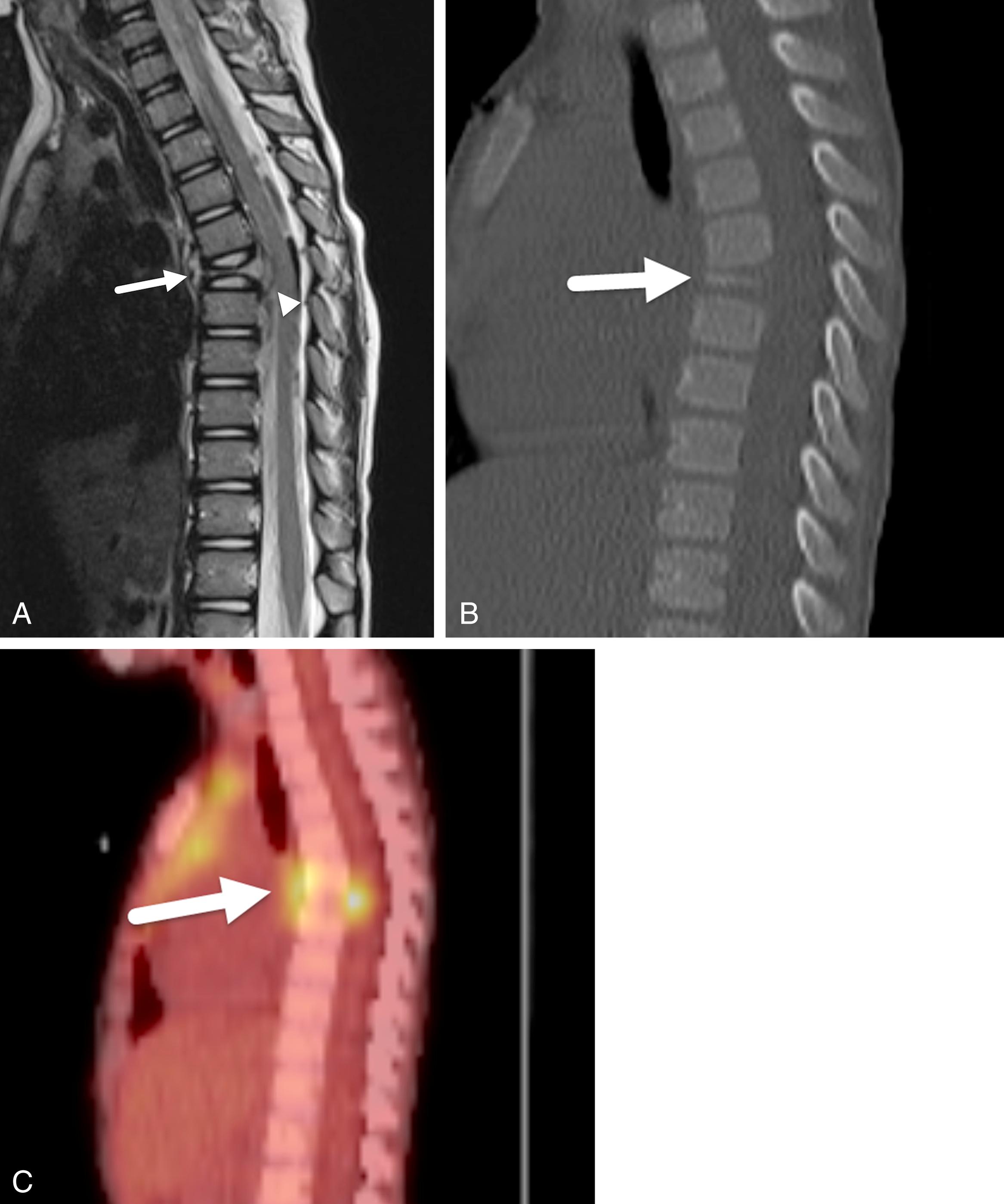 FIGURE 7-55, Langerhans cell histiocytosis.