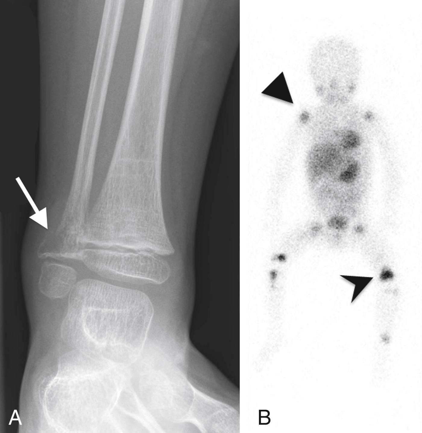 FIGURE 7-59, Metastatic neuroblastoma.