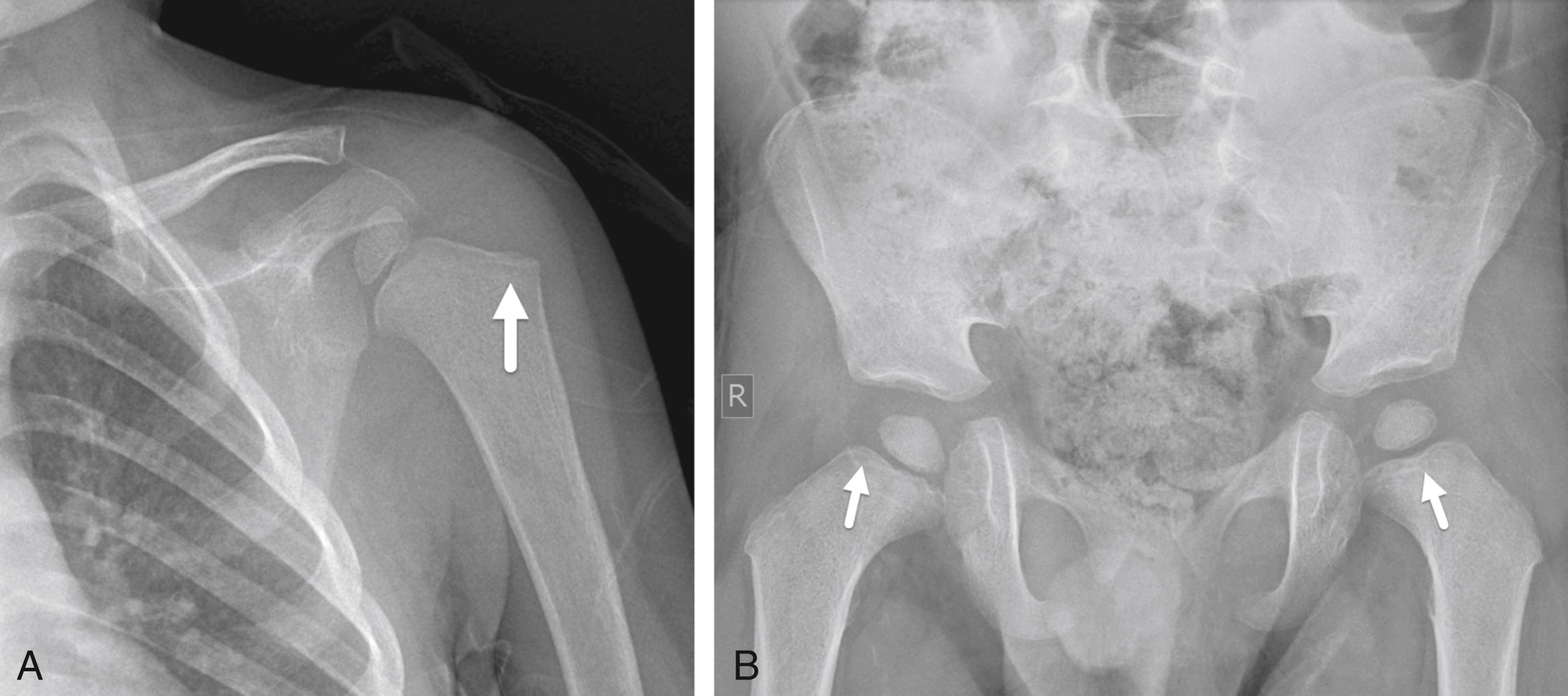 FIGURE 7-60, Leukemic lines.