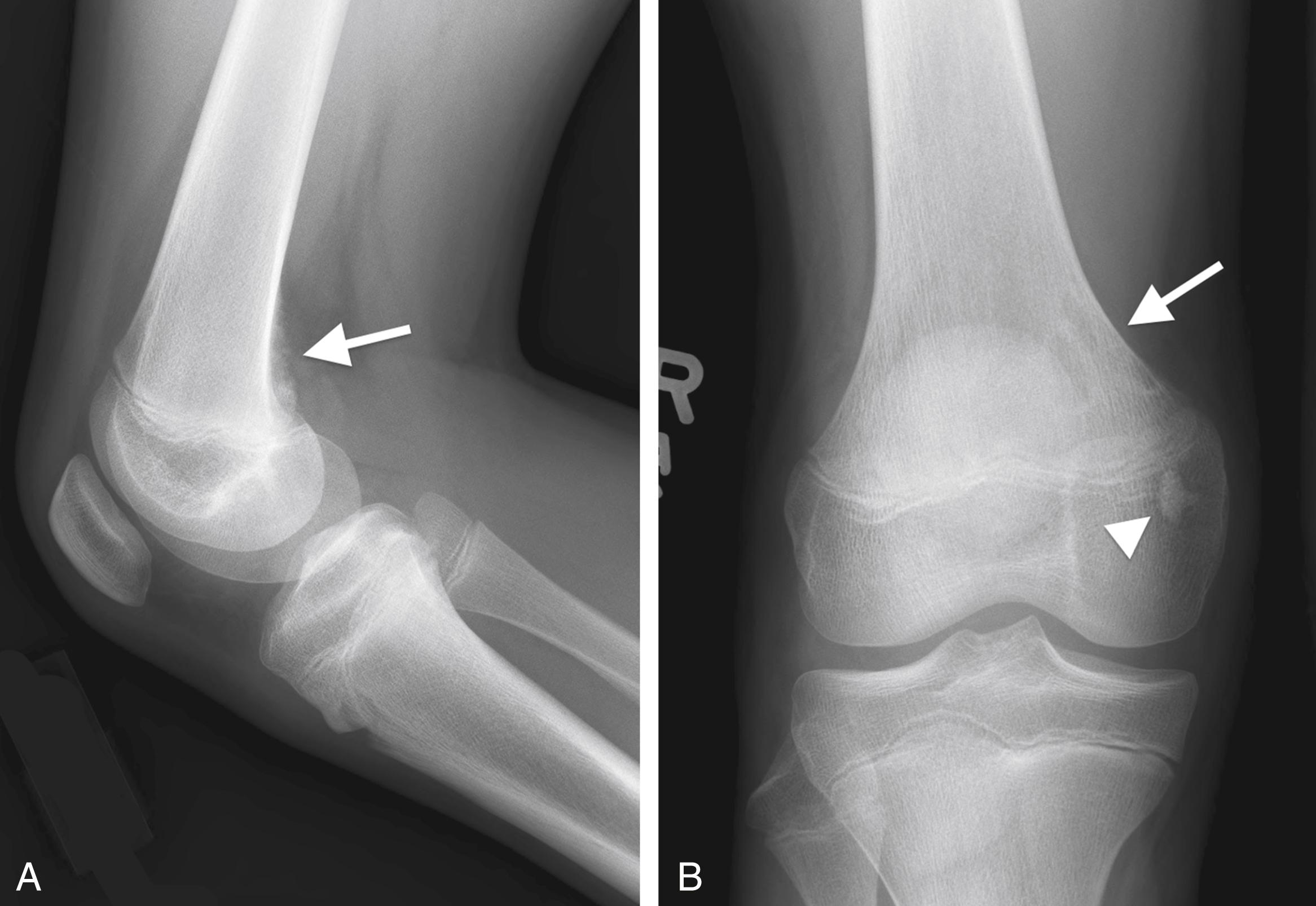 FIGURE 7-6, Distal femoral metaphyseal irregularity.