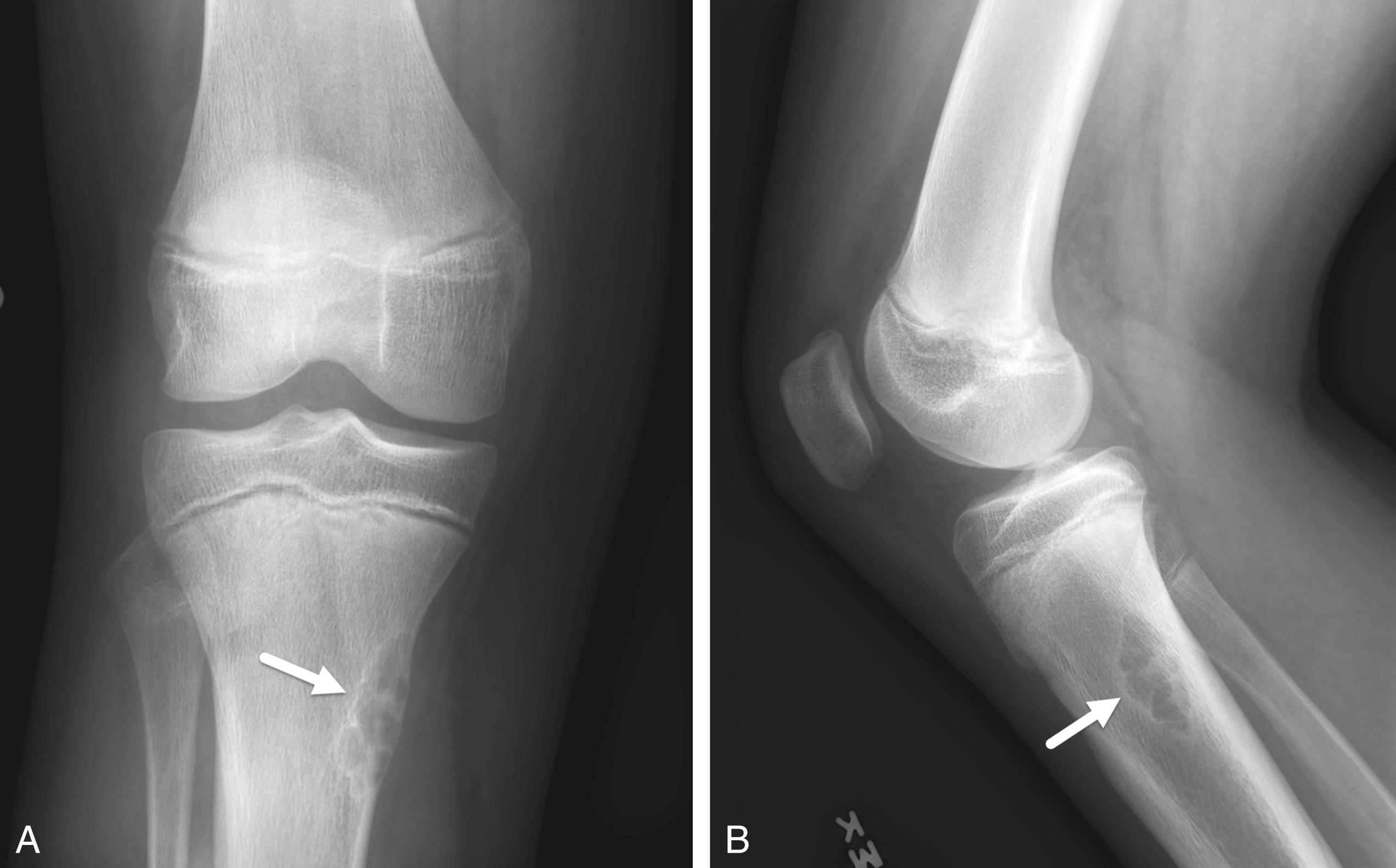 FIGURE 7-7, Nonossifying fibroma.