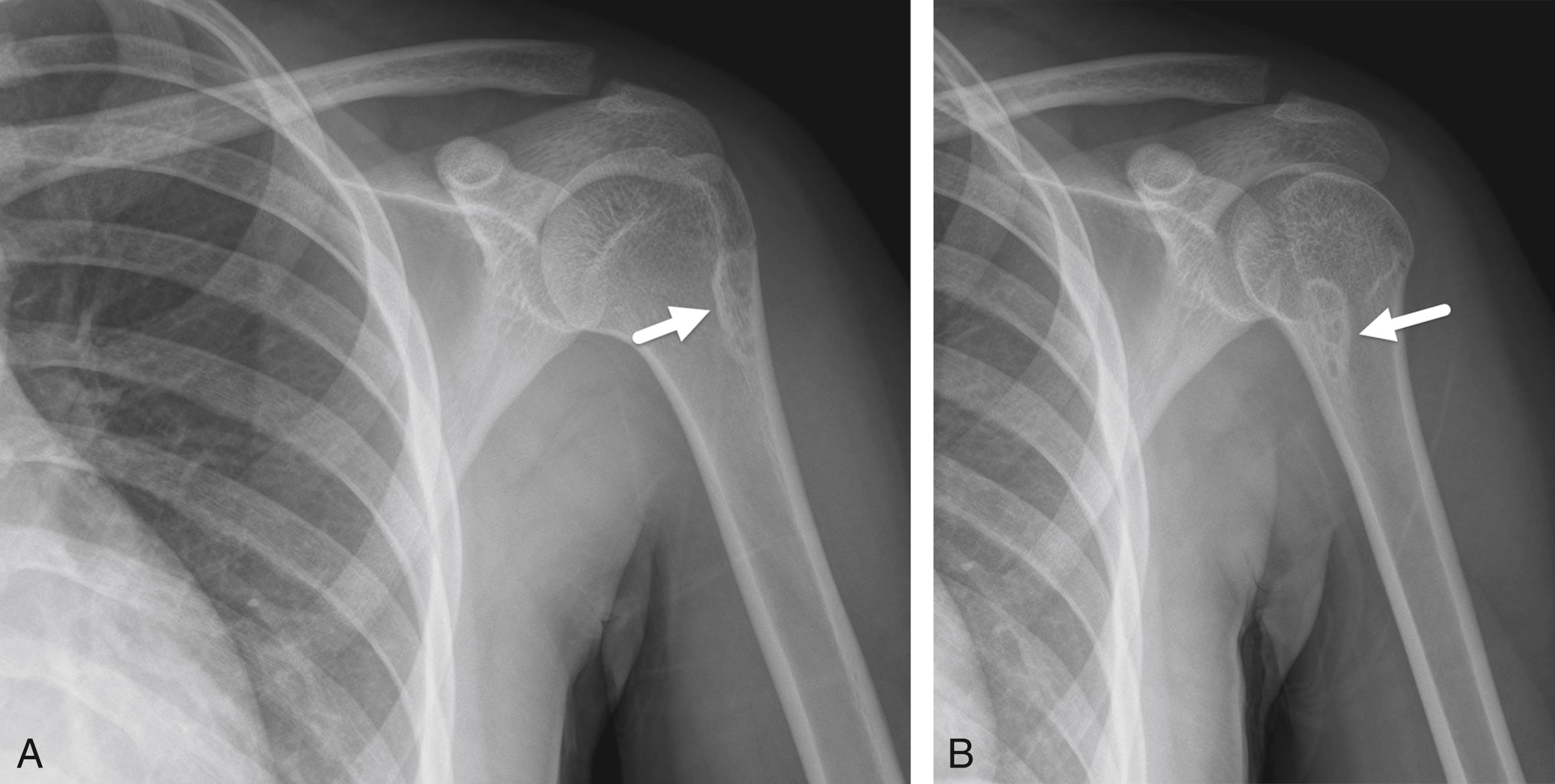 FIGURE 7-8, Benign fibrous cortical defect.