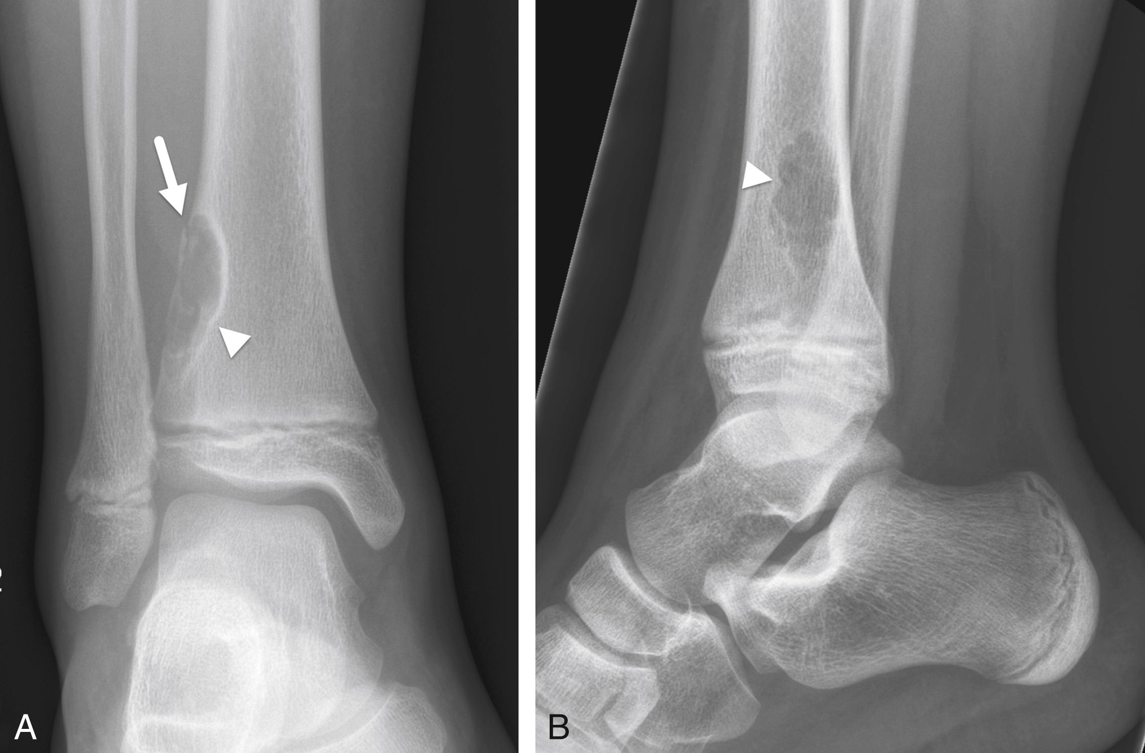 FIGURE 7-9, Pathologic fracture through a nonossifying fibroma.