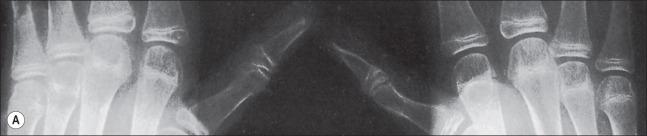 Fig. 48.2, (A) Advanced osteoporosis in the hands of a 14-year-old boy 9 months after a 100% total body surface area burn. All growth plates are open. (B) At 24 months after injury, osteoporosis persists, and there is irregular closure of the metacarpal and phalangeal growth plates. (C) At 8 months after injury, the growth plates of the distal tibiae and fibulae remain open. (D) At 24 months after injury, the distal growth plates of the tibiae and fibulae are closed. Other major growth plates remain open. Osteoporosis is unchanged.