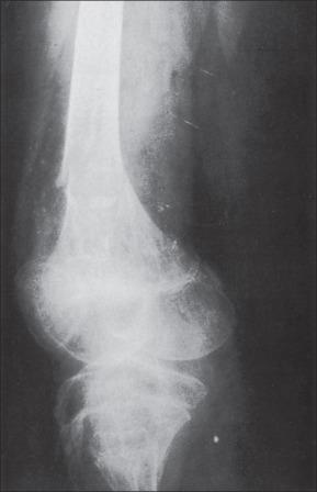 Fig. 48.3, Pathological fracture of the osteoporotic femur of a 9-year-old girl sustained on the first day she stood after 5 weeks of confinement for a 40% total body surface area burn.
