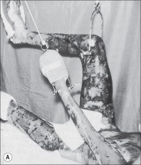 Fig. 48.4, (A) This 15-year-old boy sustained closed fractures of the right femur, left tibia, and left humerus at the time of a 46% total body surface area burn involving mainly the trunk and right lower extremity. The femur and humerus fractures were treated in skeletal traction. Suspension of the right lower extremity aided management of circumferential deep burns of that extremity. Lesser burns of the left leg made it possible to treat the minimally displaced fracture of the left tibia in a circular cast. All fractures consolidated in 6 weeks in satisfactory alignment. (B) Fracture of the left humerus as it appeared at the time of admission to the hospital. (C) At 5 weeks after injury, the fracture shows maturing callus. Traction was discontinued at 6 weeks.