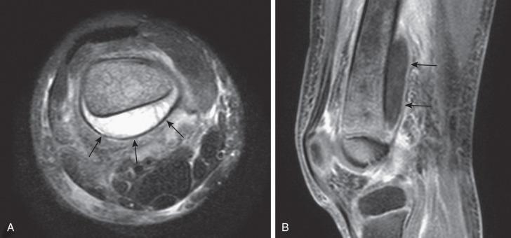 Figure 137.13, Acute osteomyelitis of the distal femur in a 5-year-old boy.