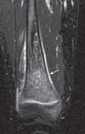 Figure 137.14, Femoral osteomyelitis in a 13-year-old girl.