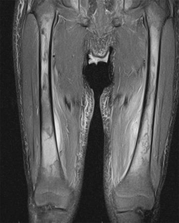 Figure 137.15, Bilateral acute femoral osteonecrosis in a 5-year-old boy with sickle cell disease.