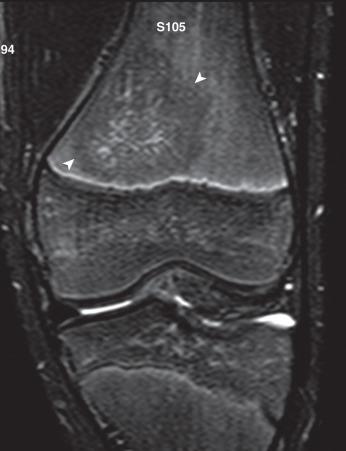 e-Figure 137.9, Biopsy-confirmed osteomyelitis in a 13-year-old boy.