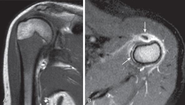 e-Figure 137.11, Proximal humeral osteomyelitis in a 12-year-old girl.