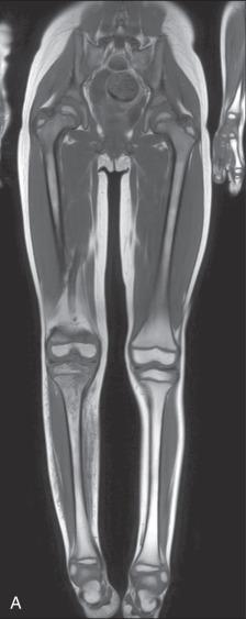 Figure 137.16, Osteomyelitis in a 5-year-old girl with fever of unknown origin.