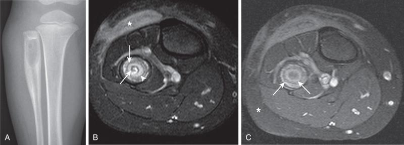 Figure 137.17, Brodie abscess in a 3-year-old boy.