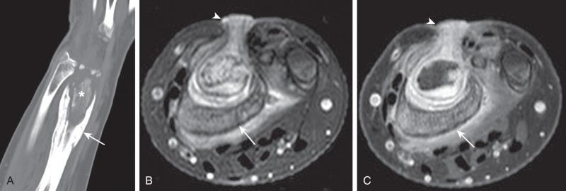 Figure 137.18, Chronic osteomyelitis of the distal radius in a 13-year-old girl.