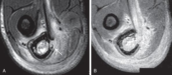 e-Figure 137.19, Chronic osteomyelitis and cloaca in a 17-year-old boy.