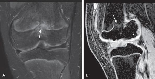 Figure 137.20, Remote history of distal femoral osteomyelitis and septic arthritis in a 14-year-old boy.