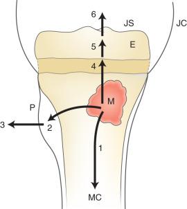 Figure 137.2, Pathways of infection after hematogenous implantation in the metaphysis and formation of a metaphyseal focus (M) of bone infection (bone abscess).