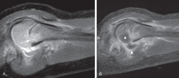 Figure 137.21, Acute proximal humeral osteomyelitis and septic arthritis in a 3-month-old boy.