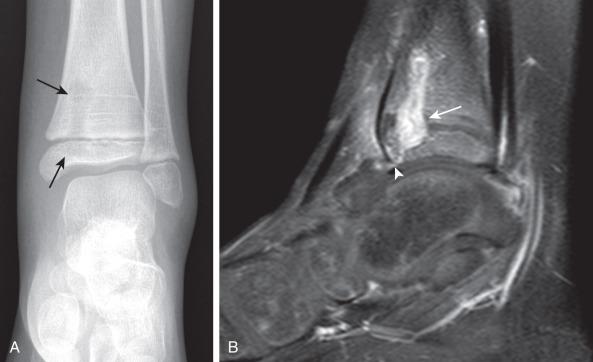 Figure 137.3, Osteomyelitis in a 6-year-old girl.