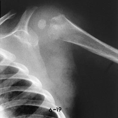 Figure 137.4, Early radiographic changes of osteomyelitis in the proximal left humeral metaphysis.