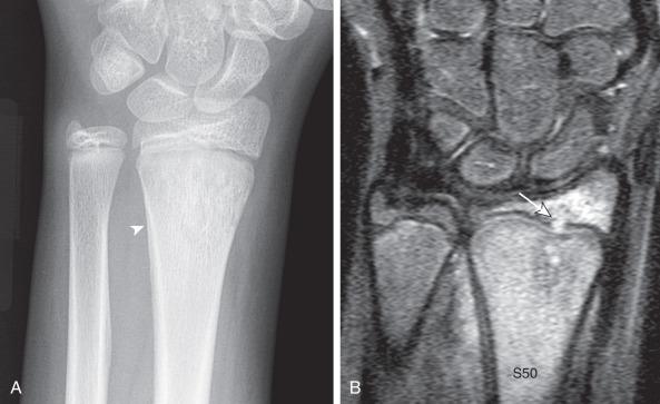 Figure 137.5, Osteomyelitis in a 12-year-old boy.