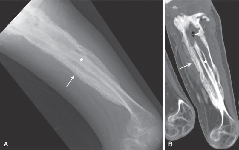 Figure 137.6, Chronic osteomyelitis of the left femur in a 17-year-old boy.