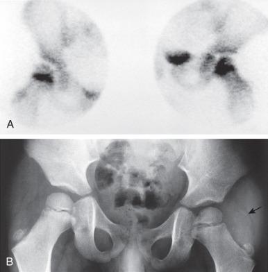 Figure 137.7, Osteomyelitis in a 4-year-old boy with fever and inability to walk or move the left lower extremity for 6 days.