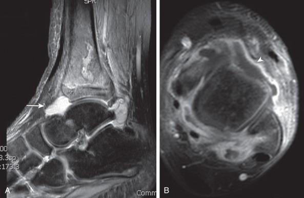 Figure 137.8, Distal tibial osteomyelitis and tibiotalar septic arthritis in an 11-year-old boy.