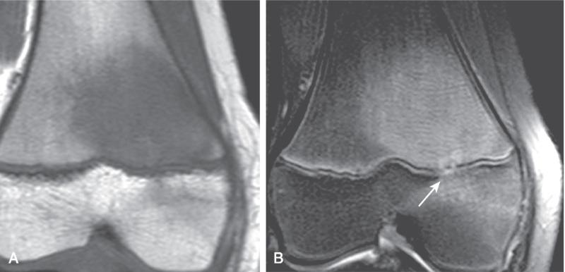 Figure 137.10, Biopsy-confirmed osteomyelitis of the distal femur.