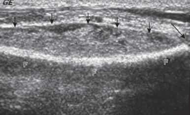 Figure 137.12, Acute osteomyelitis of the distal fibula in a 12-year-old boy.