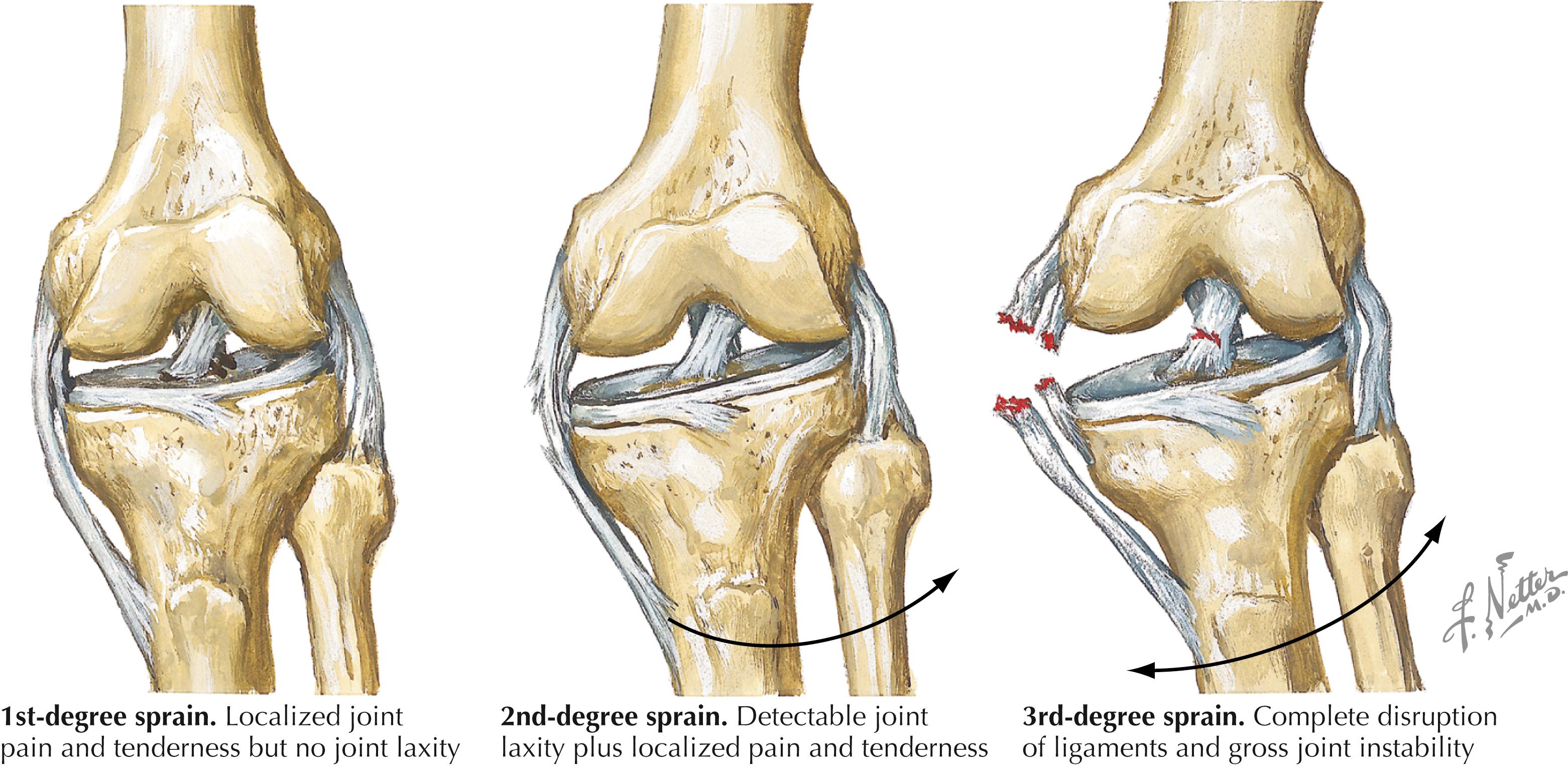 Figure 42.1, Grading of ligament sprains.