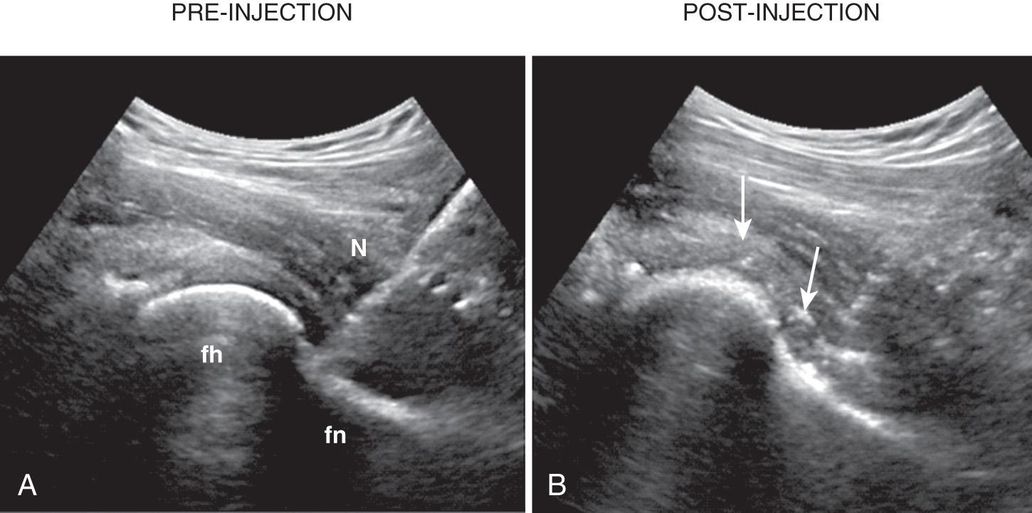 FIG. 25.3, Long-Axis Approach: Injection of Left Hip.