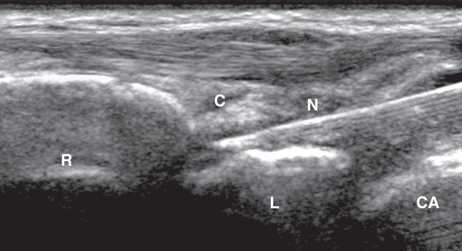 FIG. 25.5, Long-Axis Approach for Therapeutic Radiocarpal Joint Injection.