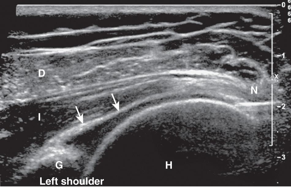 FIG. 25.6, Long-Axis Approach for Glenohumeral Joint Injection.