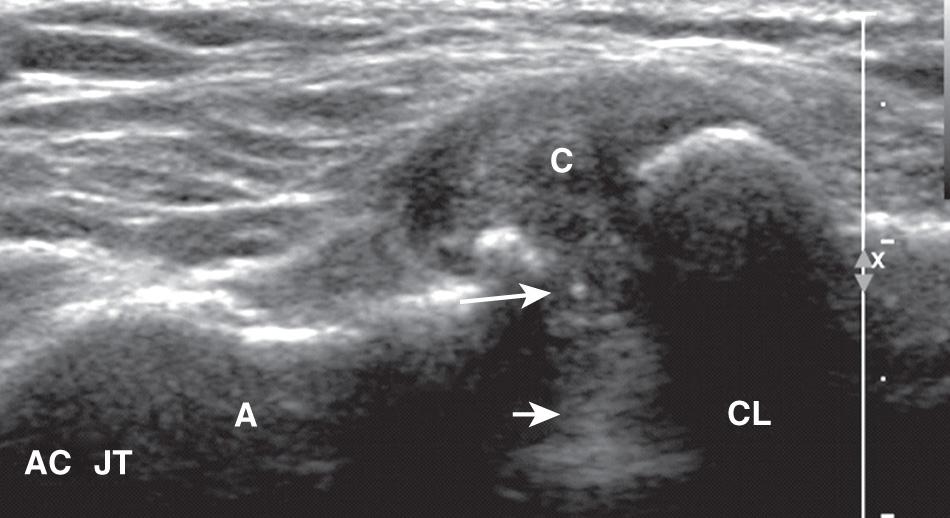 FIG. 25.7, Short-Axis Approach to Injection of Acromioclavicular (AC) Joint.