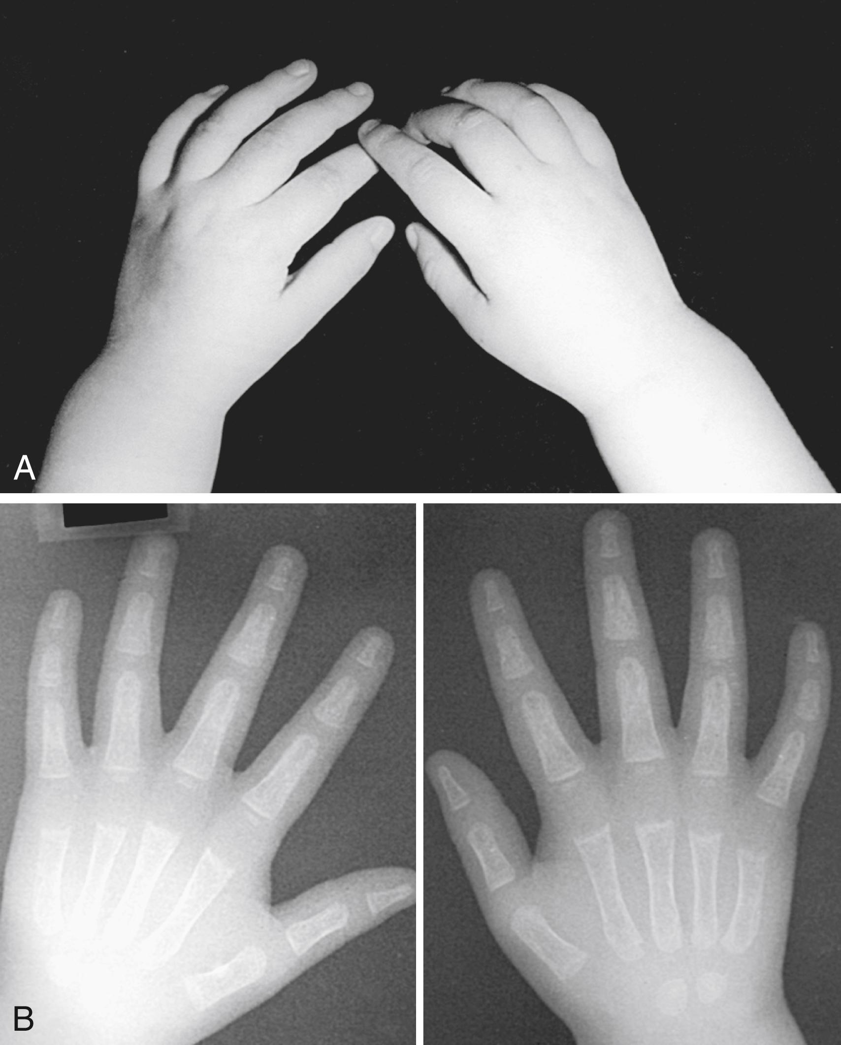 Fig. 52.1, Cystinosis. An 18-month-old girl presented with joint pain primarily involving the large joints and profound muscle weakness resulting from cystinosis. A, Hands demonstrate swelling predominantly in the metaphyseal area of the radius and ulna, but not in the wrist joint proper. B, Radiographs document metaphyseal resorption that is typical of rickets.