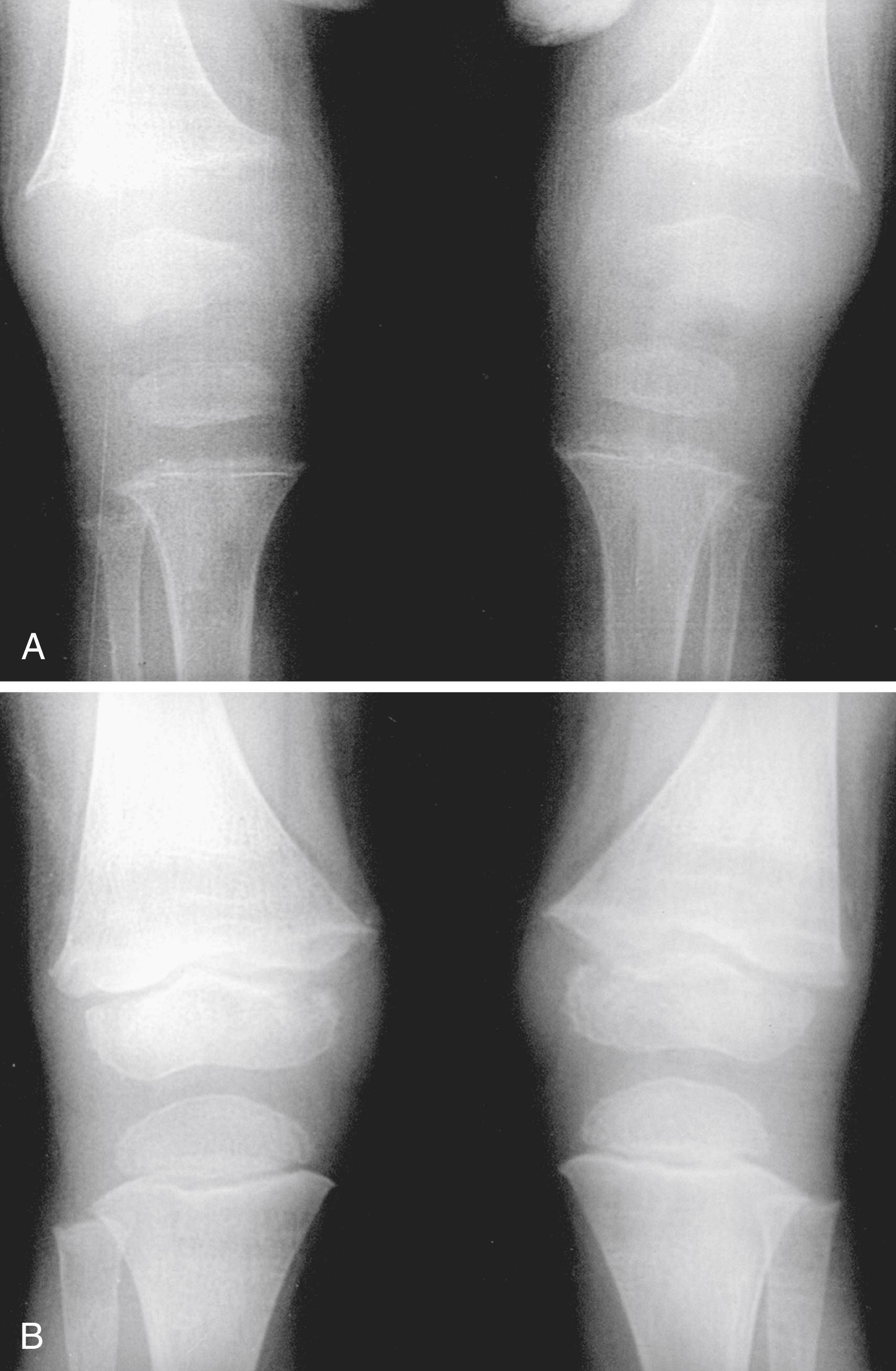 Fig. 52.3, Vitamin D–deficient rickets in a toddler. A, Radiographs of knees demonstrate rachitic metaphyseal changes, indistinct cortices, and poorly defined trabeculation. The zone of provisional calcification is almost absent, the axial height of the epiphyseal plate is markedly increased, and cupping is evident. B, X-ray films taken 6 months later demonstrate progressive healing with replacement of vitamin D.