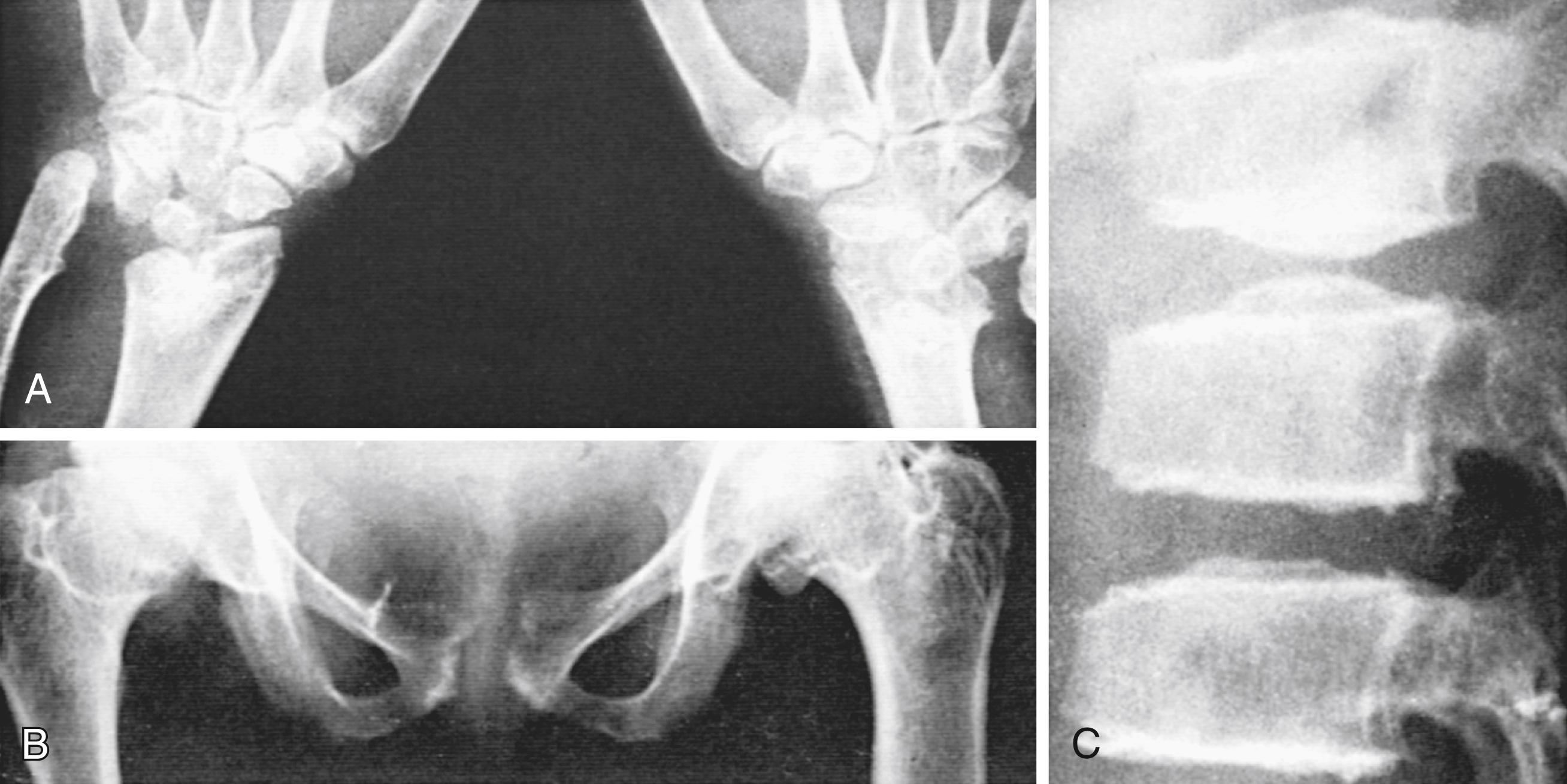 Fig. 52.4, Mseleni joint disease. A, Irregularity and deformity of the distal ends of the ulna and radius with distraction of the radius from the ulna. B, Marked deformation of the femoral heads. C, Platyspondyly.