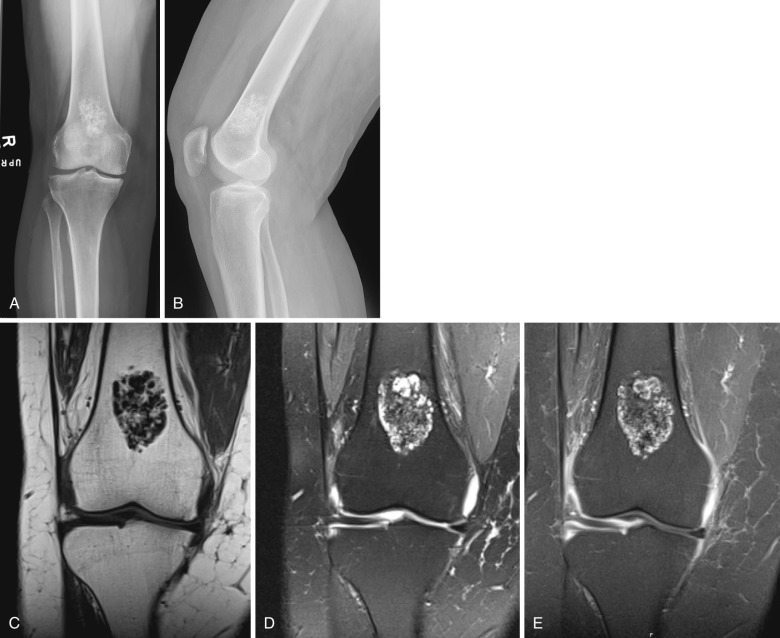 FIG 60-1, Enchondroma found incidentally on MRI in a 70-year-old woman. A and B, AP and lateral radiographs of the right knee demonstrate a lesion with ring-and-arc chondroid matrix mineralization in the distal femoral metadiaphysis. Coronal T1-weighted ( C ), T2-weighted ( D ), and T1-weighted fat-saturated postgadolinium ( E ) images demonstrate lobulated intramedullary lesion with heterogeneous areas of increased signal intensity on T2 corresponding to chondroid matrix, and low signal on all sequences corresponding to areas of matrix calcification. T1-weighted fat-saturated postgadolinium images demonstrate enhancement of cartilaginous tissue.