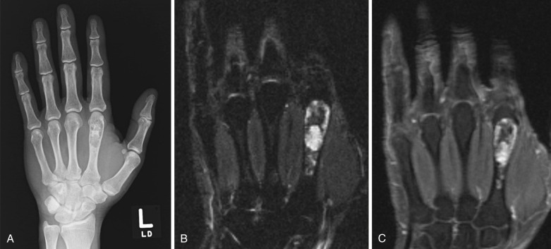 FIG 60-2, Enchondroma in a 60-year-old man with hand pain. A, AP radiograph of left hand. Coronal STIR ( B ) and T1-weighted fat-saturated postgadolinium ( C ) images demonstrate an expansile lytic lesion with ring-and-arc mineralization and endosteal scalloping in the distal second metacarpal. T1- and T2-weighted images demonstrate heterogeneous peripheral signal intensity and enhancement of the second metacarpal. Pathology post curettage showed enchondroma with no evidence of chondrosarcoma.