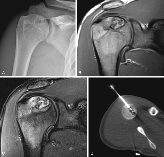 FIG 60-3, Chondroblastoma in a 19-year-old male with shoulder pain. A, AP radiograph demonstrates a lytic lesion with sclerotic rim in the right humeral head epiphysis. Coronal proton density ( B ) and T2-weighted fat-saturated ( C ) images demonstrate T2 heterogeneous hyperintensity with low signal foci and surrounding bone marrow edema. D, Axial CT fluoroscopic image with core biopsy needle within the lesion.