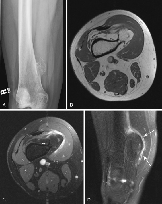 FIG 60-4, Osteochondroma in a 23-year-old woman with knee pain. A, AP radiograph of the distal femur. On MRI, T1-weighted axial ( B ), T2-weighted fat-saturated axial ( C ), and T1-weighted fat-saturated coronal postgadolinium ( D ) images show a pedunculated lesion arising from the distal medial cortex of the femur, with cortical and medullary continuity and a thin overlying cartilage cap. Overlying the lobulated cartilaginous cap is a thin rim of high T2 signal of the formed bursa, with surrounding bursal enhancement from bursitis (arrows).