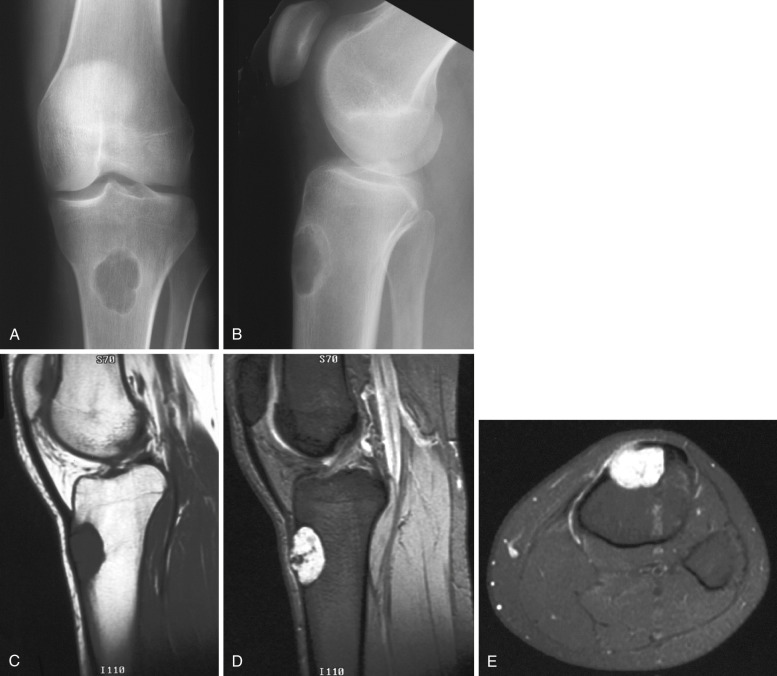 FIG 60-5, Chondromyxoid fibroma of the tibia in a 25-year-old woman with knee pain. AP ( A ) and lateral ( B ) radiographs, as well as sagittal T1-weighted ( C ), sagittal T2-weighted fat-saturated ( D ), and axial T2-weighted fat-saturated ( E ) images demonstrate eccentrically located lytic lesion at the tibial tubercle, with endosteal scalloping and sclerotic margins. MRI demonstrates hypointensity on T1 and hyperintensity on T2. No ring-and-arc matrix mineralization is seen on radiographs but can often be seen on CT.