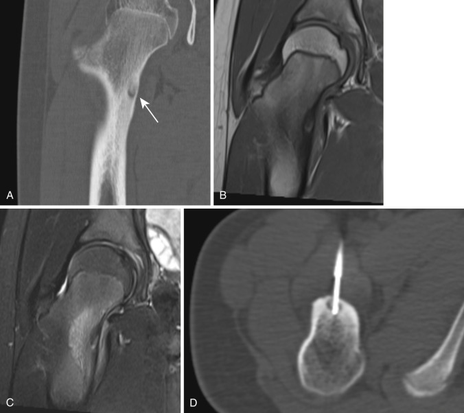 FIG 60-6, Osteoid osteoma in a 12-year-old girl with hip pain, worse at night. Coronal CT reconstruction ( A ), coronal T1-weighted MRI ( B ), and coronal STIR MRI ( C ) through the right proximal femur show medial femoral neck sclerosis and eccentric lytic component with central sclerotic nidus ( arrow in A ). On MRI there is corresponding bone marrow edema with high signal on STIR and low signal on T1-weighted images. The central nidus is hypointense on both STIR and T1. D, Axial CT fluoroscopic image with ablation of the lesion via anterior approach.