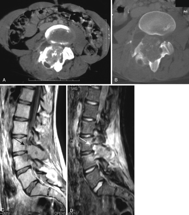 FIG 60-7, Osteoblastoma in a 26-year-old man with back pain. Axial CT in soft tissue ( A ) and bone windows ( B ), as well as sagittal T1- ( C ) and T2-weighted ( D ) MRI demonstrate a large, expansile, lytic lesion in the posterior elements, with internal osteoid matrix and surrounding dense sclerosis. On MRI the lesion is hypointense on T1 ( arrow in C ), corresponding to areas of mineralization, and hyperintense on T2 ( arrow in D ), with surrounding peritumoral edema.